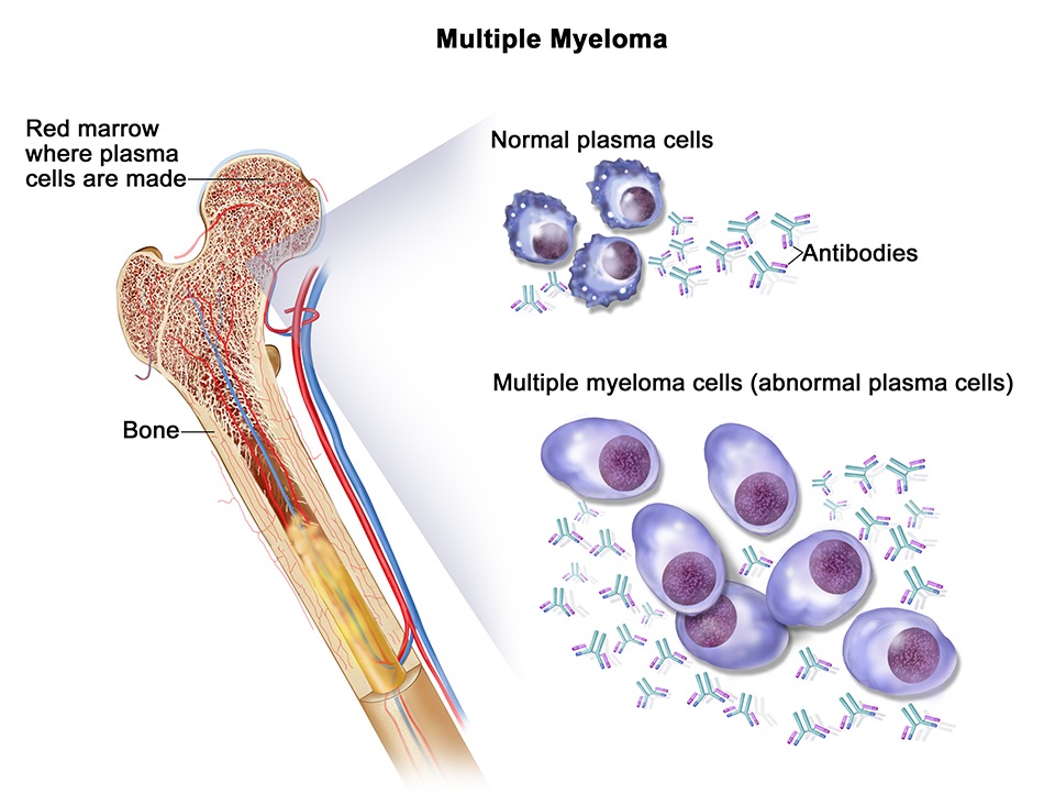 multiple_myeloma_diagram_english.jpg